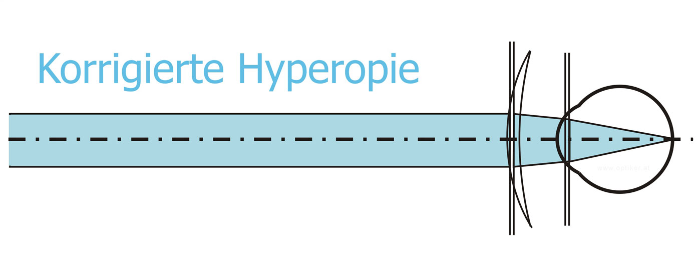 Korrigierte Hyperopie - Übersichtigkeit - Weitsichtigkeit