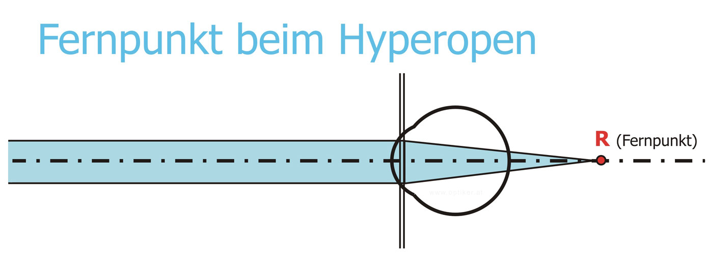 Hyperopie - Übersichtigkeit - Weitsichtigkeit 