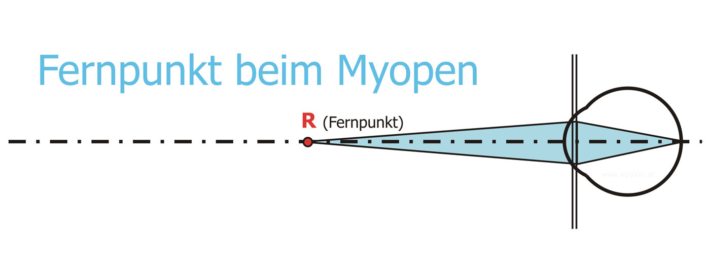 Myopie - Kurzsichtigkeit